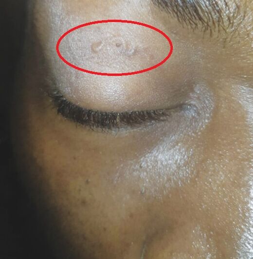 Diagnosed ophthalmodirofilariasis