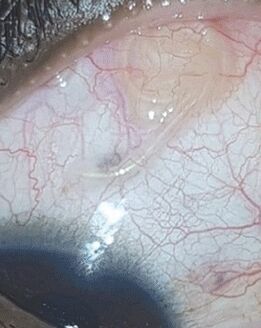 NEOflorax helped to get rid of the worm in the eye