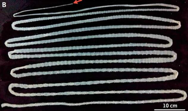 tapeworms from the human body
